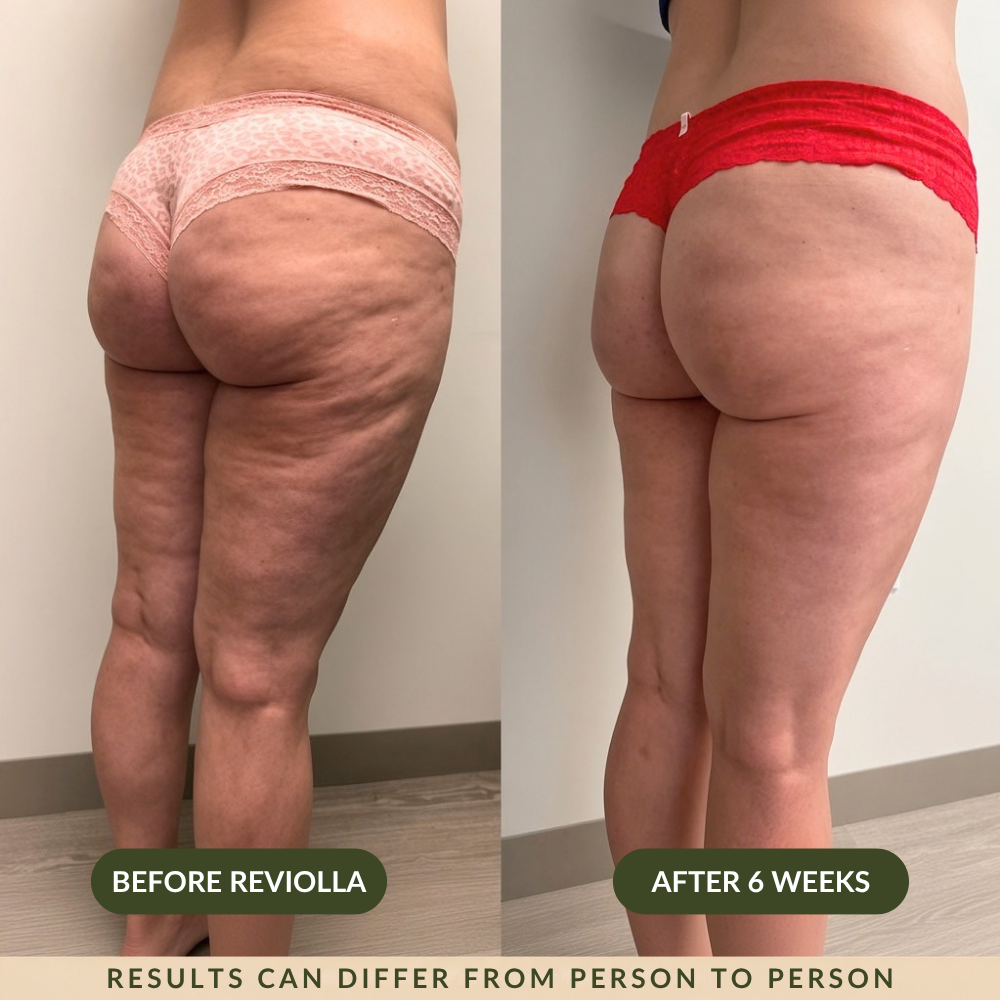 Reviolla Anti-Cellulite Massage Oil